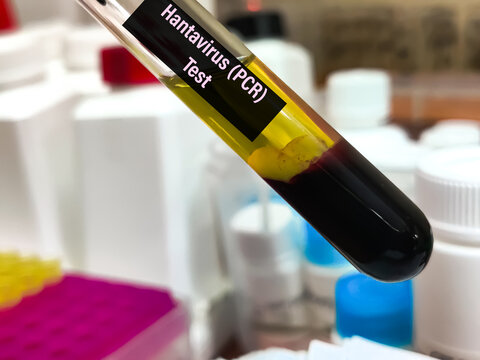 Biological Specimen blood test for detecting IgM and IgG antibodies (ELISA) or molecular PCR tests to detect viral RNA of Orthohantavirus or Hantavirus.
