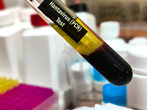 Biological Specimen blood test for detecting IgM and IgG antibodies (ELISA) or molecular PCR tests to detect viral RNA of Orthohantavirus or Hantavirus.