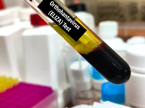 Biological Specimen blood test for detecting IgM and IgG antibodies (ELISA) or molecular PCR tests to detect viral RNA of Orthohantavirus or Hantavirus.