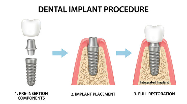 Medical illustration of the dental implant procedure showing the stages of pre-insertion components, implant placement and full restoration.