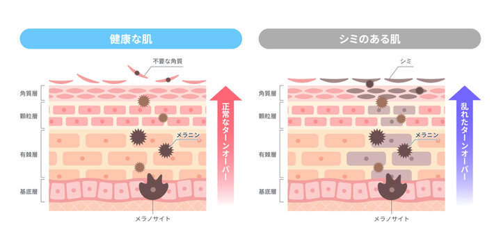 肌のターンオーバー比較・健康な肌とシミのある肌の違いとメラニンの仕組み