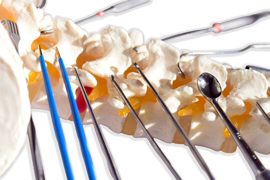 Lumbar spine model with posterior stabilization and fusion instruments. Anatomical vertebral column showing surgical tools used for pedicle screw placement and spinal decompression procedures in ortho