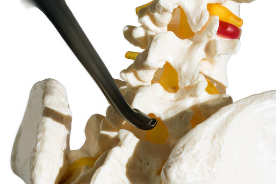 Lumbar spine model with kerrison rongeur for laminectomy procedure. Anatomical vertebral column demonstrating surgical bone removal and decompression of spinal canal for medical education and orthoped