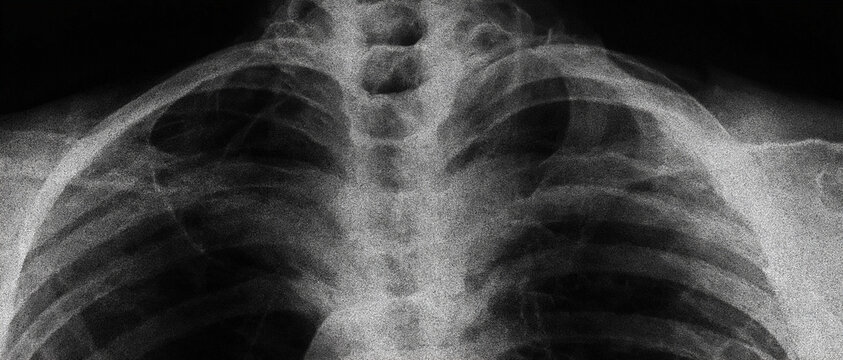Monochrome X-ray of the upper chest showing ribs and clavicles