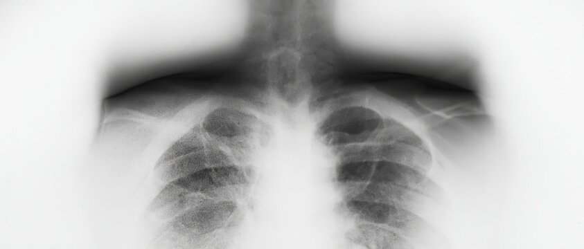 Monochrome chest X-ray showing blurred ribs and clavicle bones