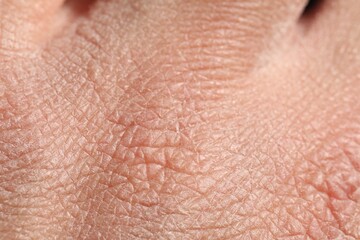 Fototapeta premium Man with dry skin on his hand, closeup