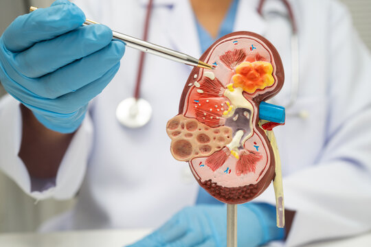 Chronic kidney disease, doctor with model for treatment urinary system, urology, Estimated glomerular filtration rate eGFR.