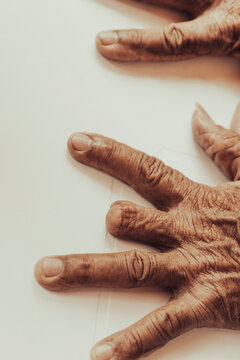Person amputated a finger on the hand