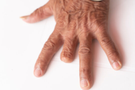 Person amputated a finger on the hand
