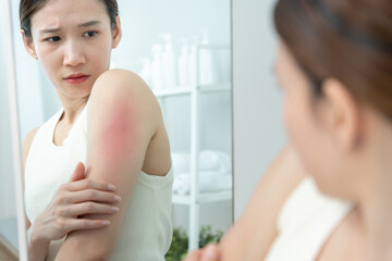 Fototapeta premium skin problem and beauty. woman scratch body has itchy skin from skin allergic, steroid allergy, sensitive skin, red from sunburn, chemical allergy, rash, insect bites, Seborrheic Dermatit