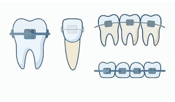 Modern orthodontic braces and teeth alignment vector collection with dental bracket system illustrations