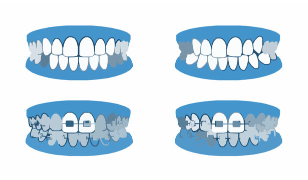 Orthodontic teeth and braces vector set with dental bracket system illustration isolated on white background