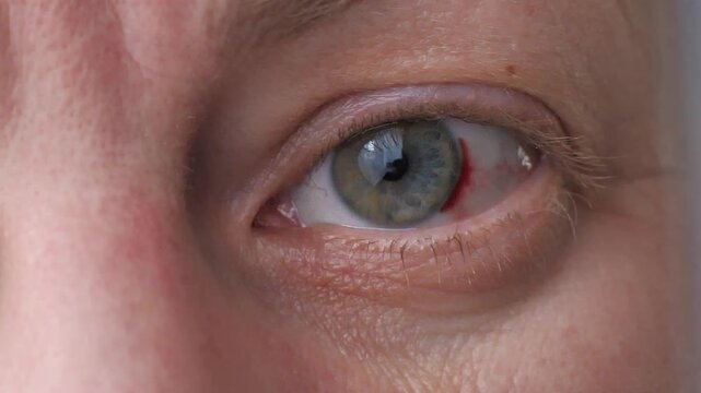 Hemorrhage on the eye (grey and green eye colour): bleeding vein on the eyeball due to straining, lifting a heavy weight or working a long time at the screen