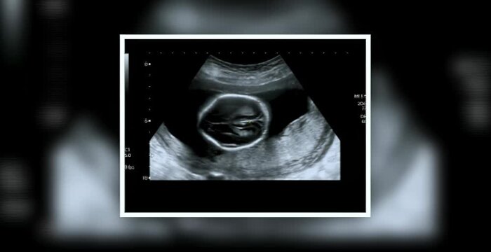 Ultrasound scan of pregnant woman showing third month fetus in medical clinic