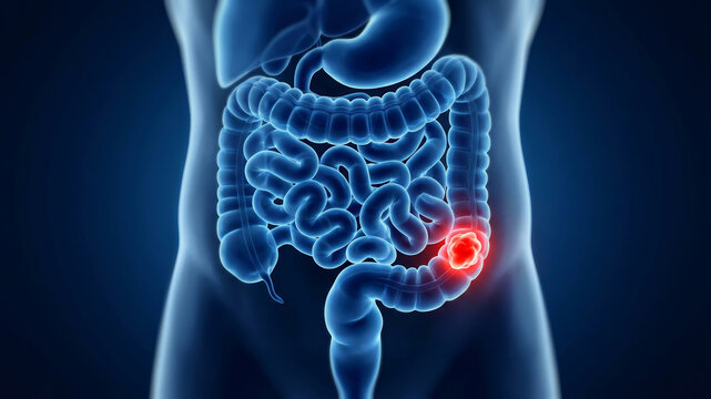 Cancer risk factor. colon intestine tumor cancer risk factor anatomy medical. Oncology patient consultation. health care diagnosis, disease prevention treatment, medicine information, danger