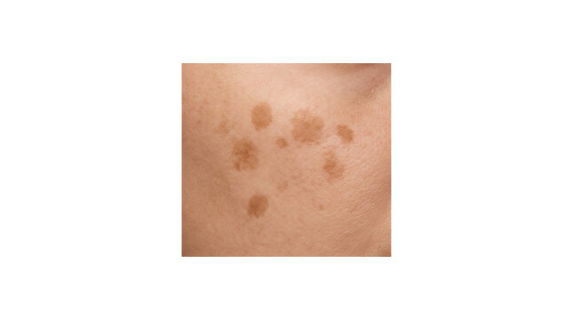 Close-up of human skin showing multiple cafe au lait spots, a form of hyperpigmentation or birthmark.