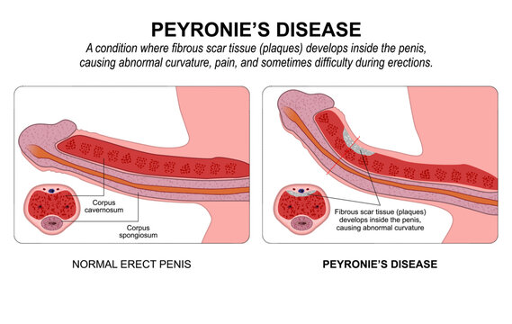Peyronie&rsquo;s Disease, Deformity of Penis