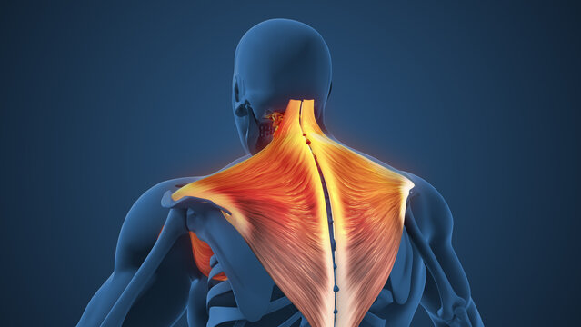 Trapezius Tightness Causing Neck Discomfort