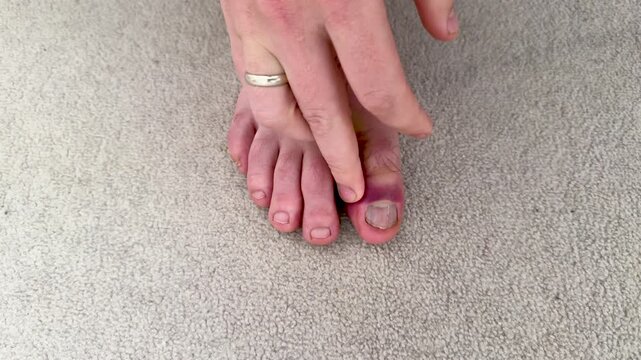 Caucasian person examines injured toe with visible bruising and swelling, gently pressing on the affected area while seated on a soft carpeted surface