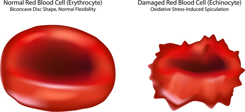 Healthy and Damaged Red Blood Cell Comparison, Echinocyte Formation and Oxidative Stress Medical Illustration. Red Blood Cell Morphology 
