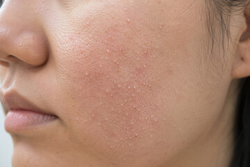 Fototapeta premium Acne on facial skin close-up for practical use