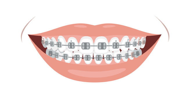 A close-up of a smiling mouth displaying metal braces and wires on the teeth, indicating orthodontic treatment for alignment.