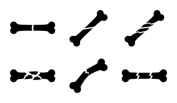 Broken bone icons set, fractured human bone vector silhouettes, medical injury and orthopedic trauma symbols, 6 black bone fracture types