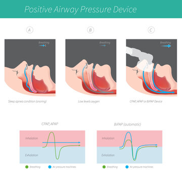 Positive Airway Pressure Device (CPAP, APAP, BiPAP) for Sleep Apnea Treatment Diagram