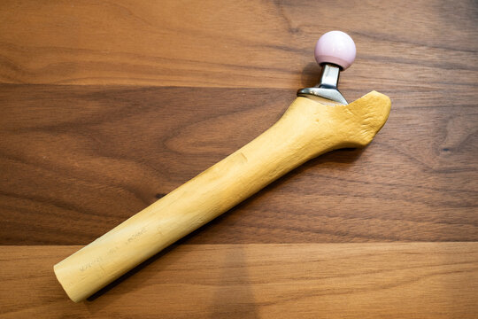 Anatomical Model of a Femoral Stem for Total Hip Replacement