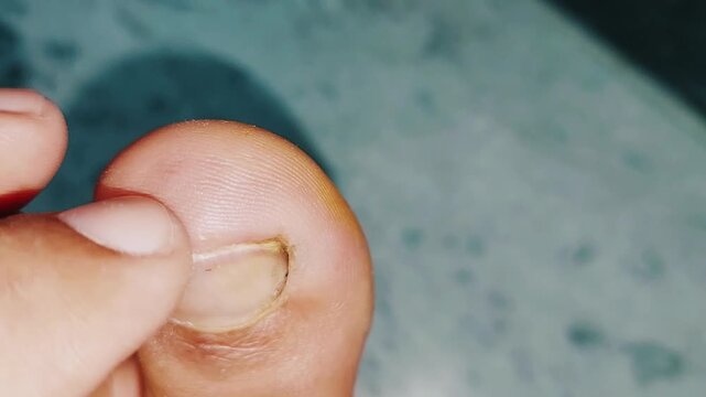Macro Close Up Of Toe Injury Caused By Hiking Impact