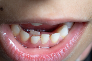Child mouth showing mixed dentition and crowding of teeth © Alessandro Grandini