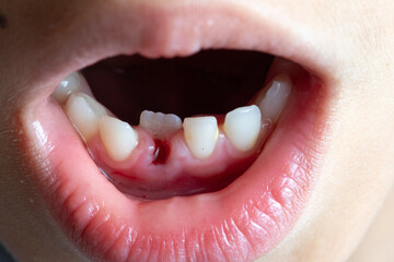 Obraz premium Child mouth showing loss of front deciduous tooth
