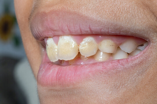 Child's teeth showing dental fluorosis and discoloration
