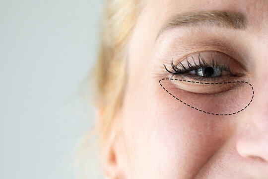 Woman's eye with drawn under-eye bags indicating aging