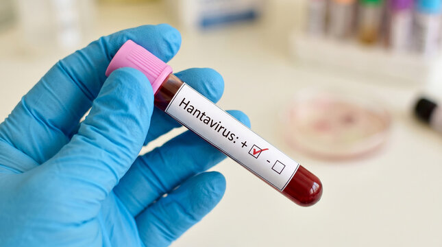 Positive Hantavirus Blood Test Result in Laboratory Tube