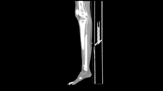 High-resolution CT scan of the human leg providing a detailed radiological view of the lower limb bone structure.