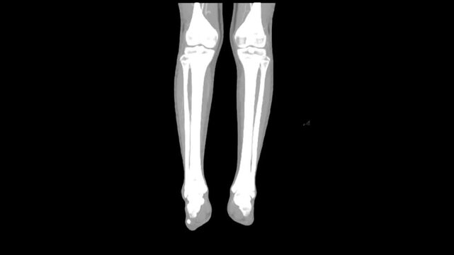 Advanced computed tomography imaging of the leg used for orthopedic diagnosis of fractures and musculoskeletal conditions.