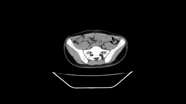 Professional medical leg scan showcasing a cross-sectional analysis of the tibia and fibula for clinical evaluation.