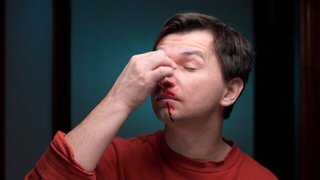 Man with a profusely bleeding nose applying pressure to his nasal bridge, dealing with epistaxis and needing first aid due to a sudden medical condition or injury