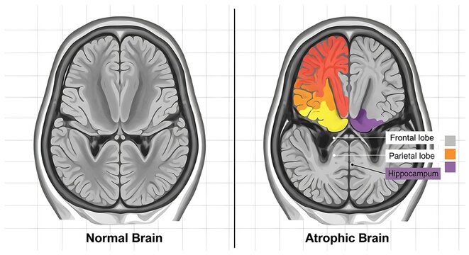 Medical Illustration of Normal and Atrophic Brain Slices Color Coded