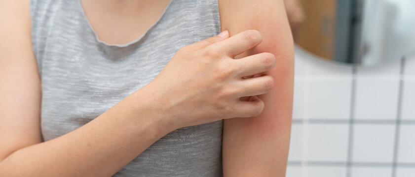 skin problem and beauty. woman scratch body has itchy skin from skin allergic, steroid allergy, sensitive skin, red from sunburn, chemical allergy, rash, insect bites, Seborrheic Dermatitis.