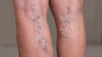 Naklejka premium Ultra-realistic medical visualization showing severe varicose veins with detailed anatomy, cinematic lighting, realistic skin textures, and premium biomedical rendering.