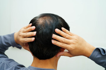 Fototapeta premium Bald head in man, hair loss treatment health problem.