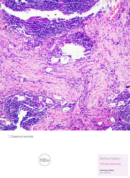 Tuberculosis is a chronic granulomatous inflammation characterized pathologically by tuberculous nodules, which consist of caseous necrosis, epithelioid cells, and macrophages.Magnify 100x.
