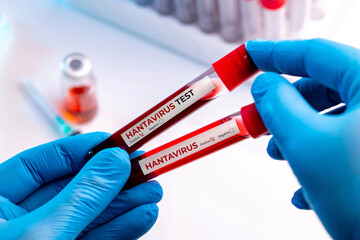 Naklejka premium Two hantavirus blood samples representing infectious disease screening concept