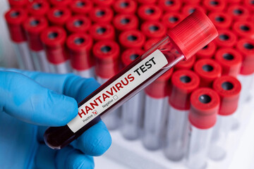 Obraz premium Hantavirus blood test tube in laboratory research and medical analysis setting