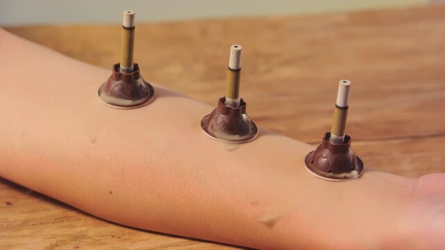 Physical therapist doing physiotherapy to patient hand, arm, leg. Orthopedic specialist osteopath apply moxibustion a traditional chinese medicine method with moxas smoking stimulating healing patient