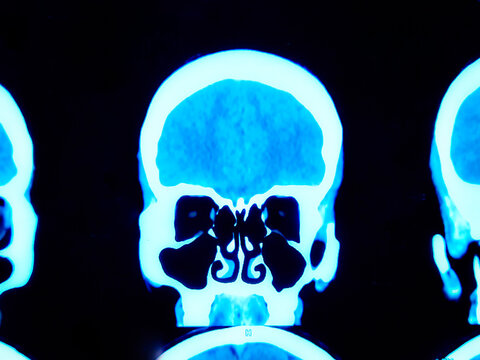 Coronal CT Scan of human head showing brain and sinuses. 