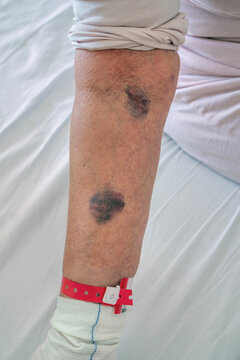 Close up of hematomas and large bruises on the arm of an elderly female patient in the hospital after blood draws caused of anticoagulation therapy or blood-thinning medications 