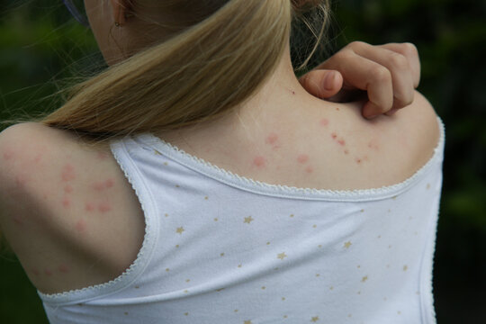 Red, swollen and itchy spots on skin caused by insect bites or allergy. Skin reaction to insect bites. 